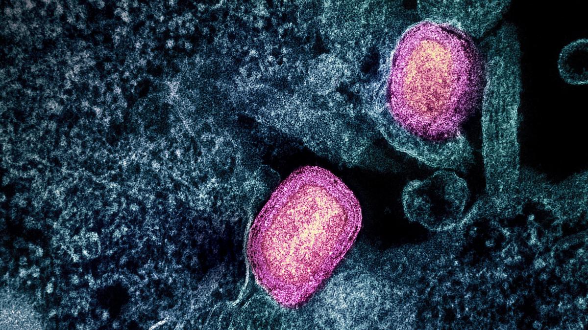 Mpox: Neue Variante breitet sich in Deutschland aus – Familie aus NRW in Quarantäne