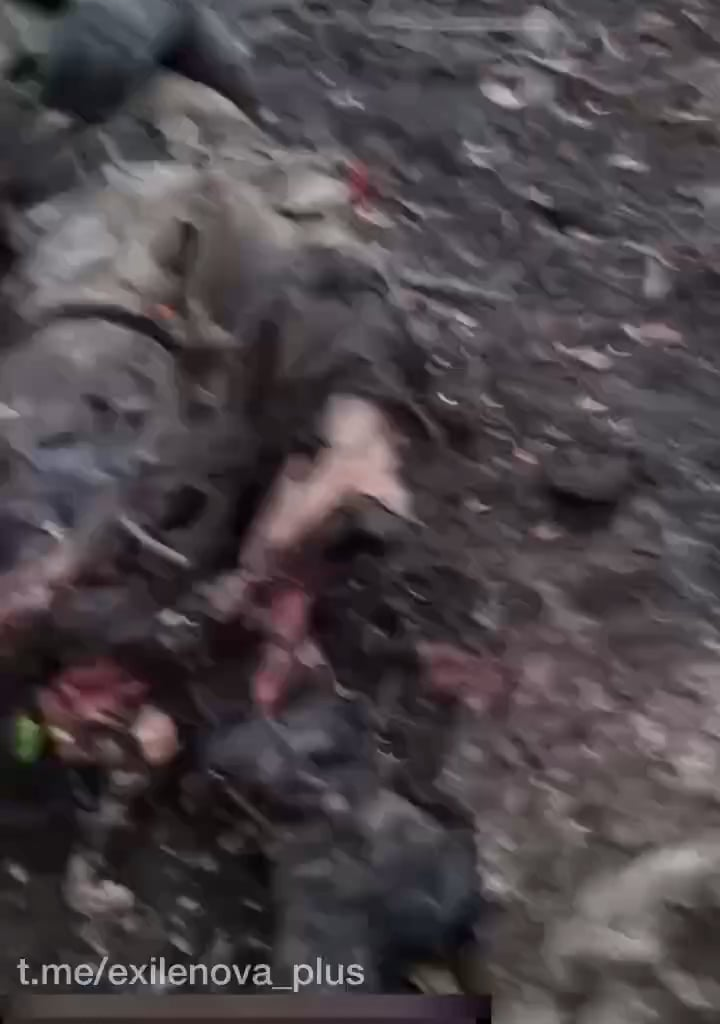 Aftermath of Russian soldier who lost his lower leg to shrapnel