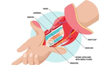 Finland performs 1st hand transplantation at HUS
