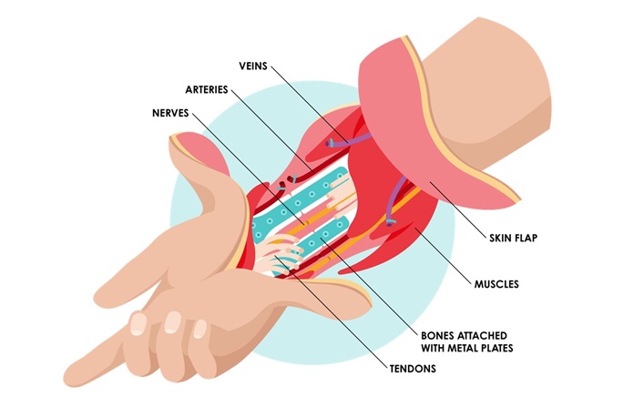 Finland performs 1st hand transplantation at HUS