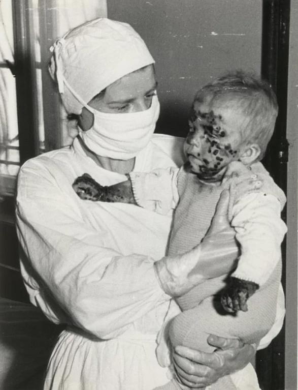 A nurse caring for a sick child during the smallpox epidemic in Wrocław, Poland, 1963.