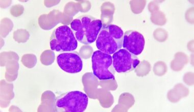 Immune environment found to influence success of leukemia immunotherapy