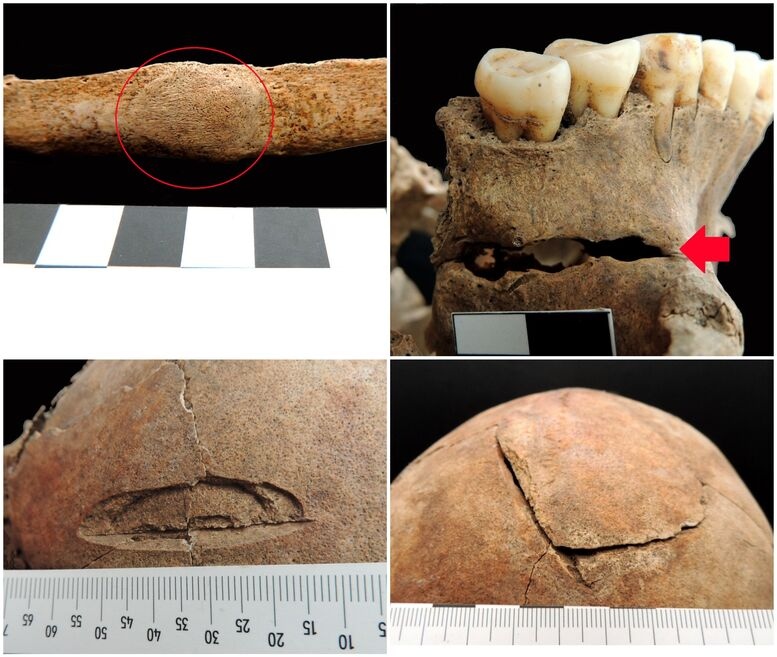 Injuries sustained during life (pictures above) and two to the skull that were the cause of death. Credit: Nataša Šarkić