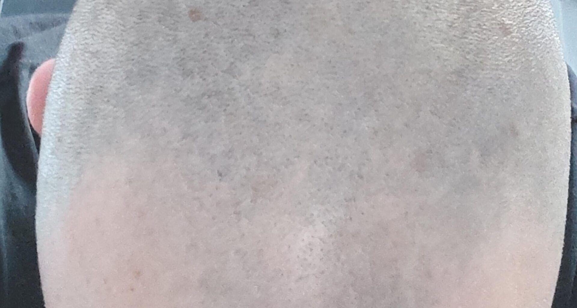 Update to the bald advice I was asking a few days ago.