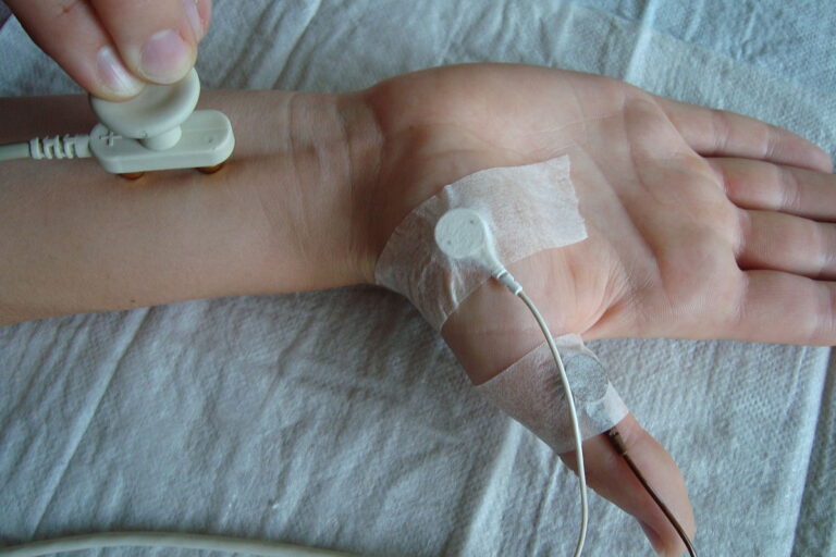 Nerve conduction velocity Guillane-Barré syndrome