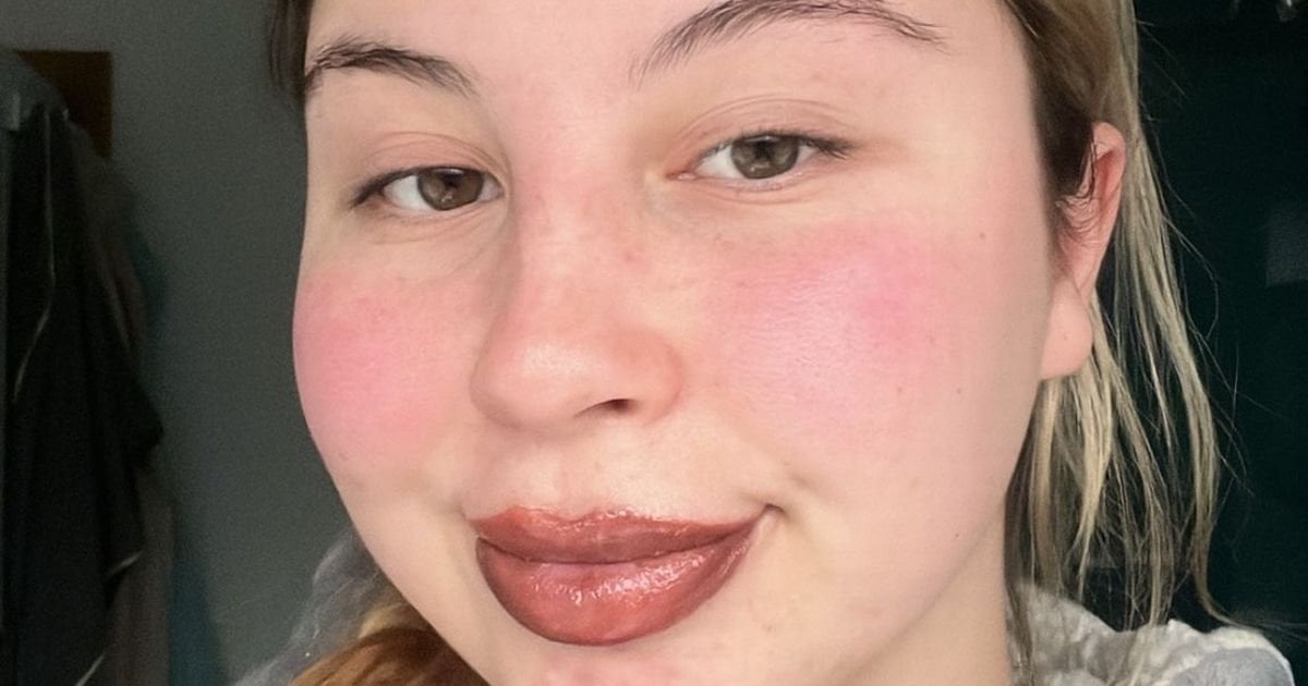 'Fillers turned me into a Monsters Inc character, I had to wear a mask in Asda'