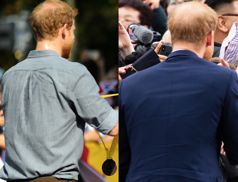 Prince Harry's receding hairline, shown from behind in two photos.