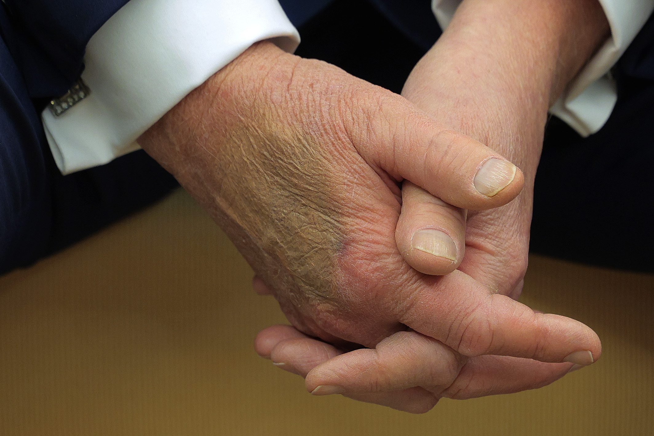Trump Hand Bruise