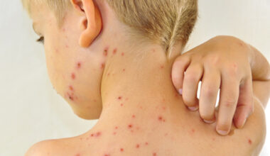 Over 120,000 measles cases in Europe and Central Asia. In Moldova – 217