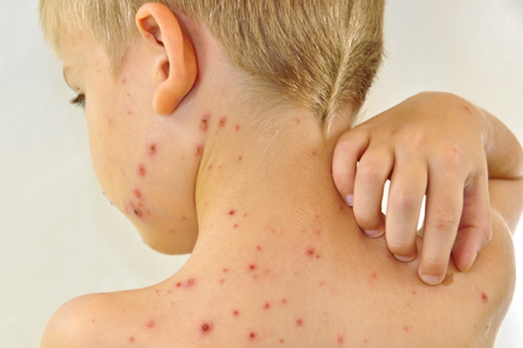 Over 120,000 measles cases in Europe and Central Asia. In Moldova – 217