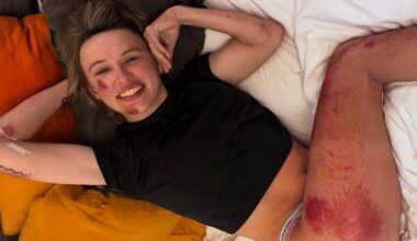 VIDEO. Niet voor gevoelige kijkers: Tourwinnares Katarzyna Niewiadoma toont pijnlijke gevolgen van valpartij in Strade Bianche