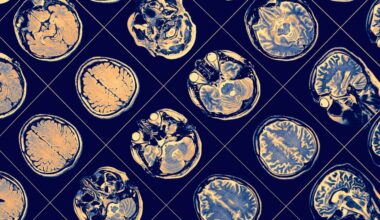 Brain Mri