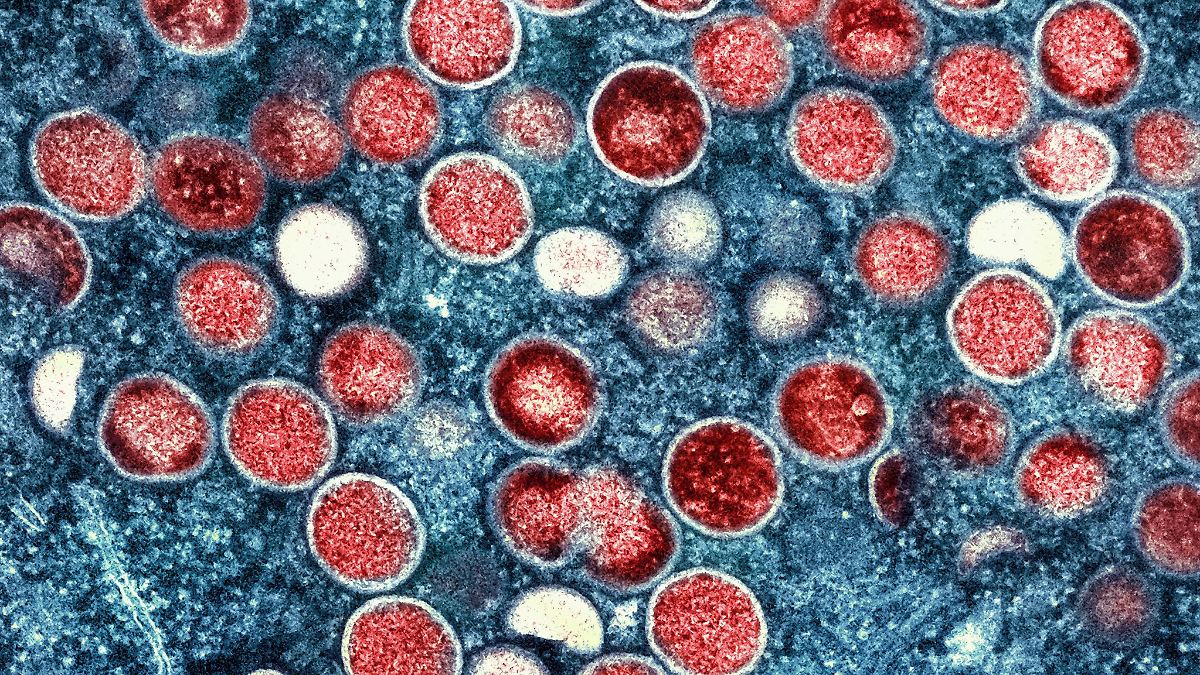 Höchste wöchentliche Zahl: Infektionskrankheit Mpox breitet sich in Berlin aus