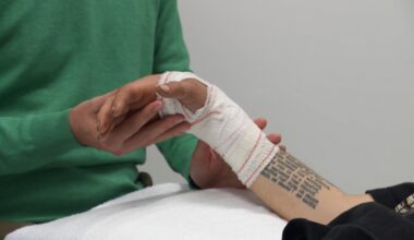 Opération exceptionnelle à Bruxelles : des chirurgiens réimplantent la main d'un patient, sectionnée par accident avec une scie circulaire
