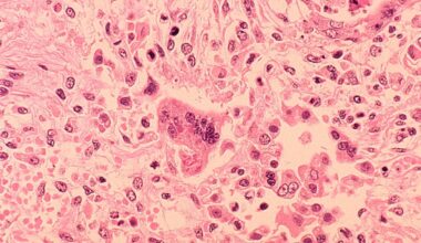 Health officials across DMV issue exposure warnings after 2 confirmed cases of measles