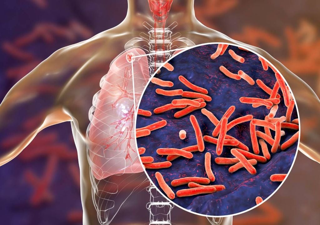 Tuberculose