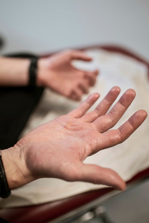 Linda berättar om skammen som kommer med sjukdomen. ”Om jag berättar att jag fixar min handsvett tror jag att folk kommer att äcklas över det”, säger hon.