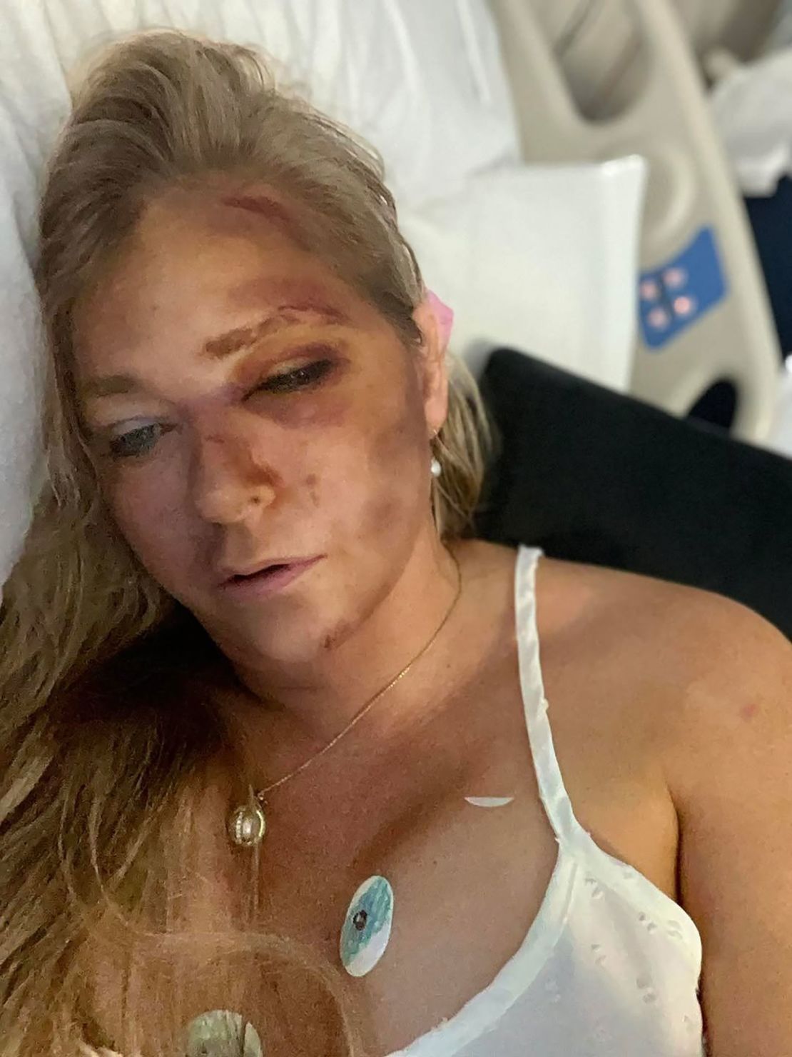 In an Instagram post on Sunday, March 30, Giuffre shared a photo of herself lying in a hospital bed with her face covered in bruises.