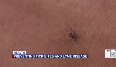 UW Health gives tips to prevent tick bites and Lyme disease