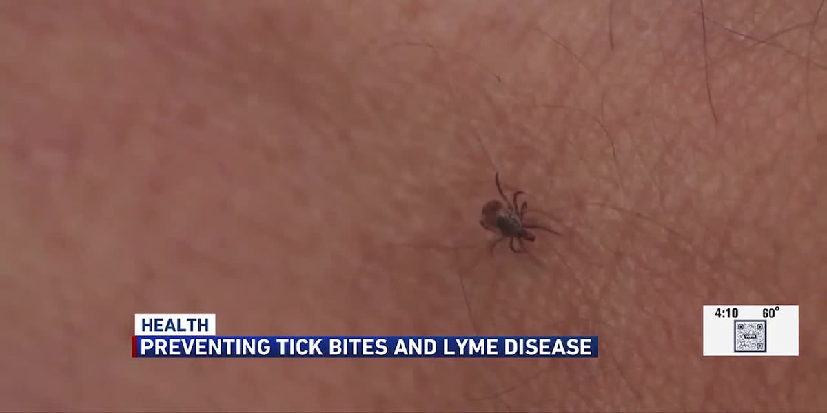 UW Health gives tips to prevent tick bites and Lyme disease