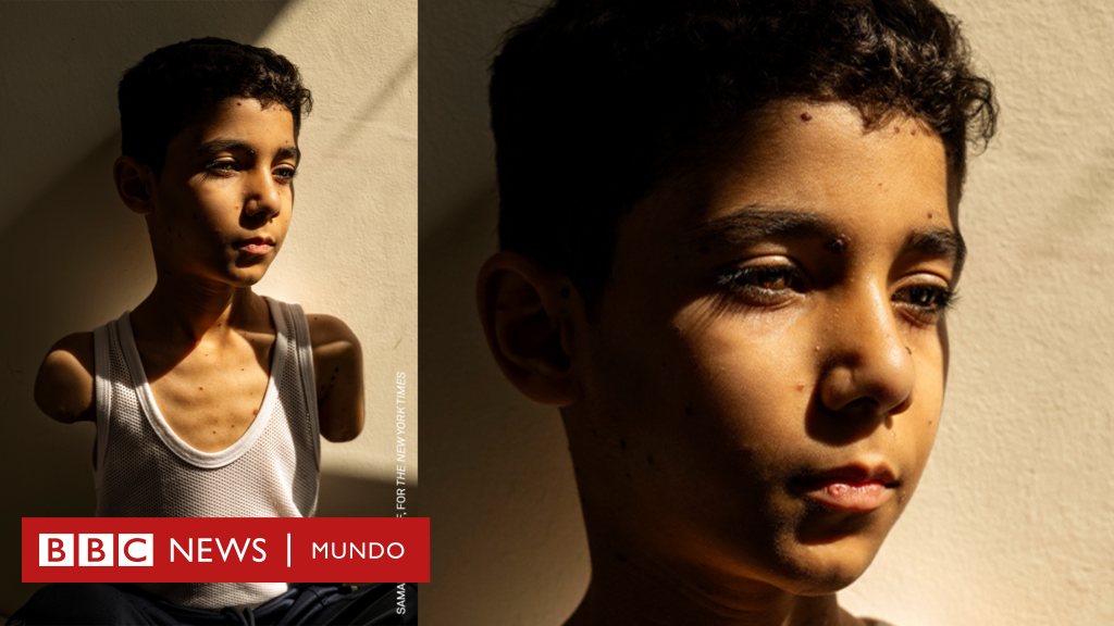 La historia detrás de la impactante imagen de un niño palestino mutilado que ganó el premio World Press Photo 2025