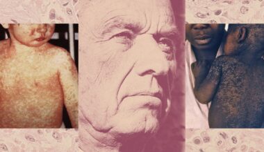 The CDC Buried a Measles Forecast That Stressed the Need for Vaccinations