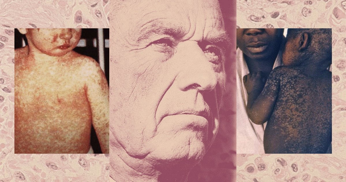 The CDC Buried a Measles Forecast That Stressed the Need for Vaccinations