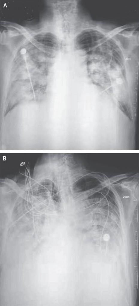 Chest X-rays of patients with Wuhan pneumonia.   (Image courtesy of the  New England Journal of Medicine )