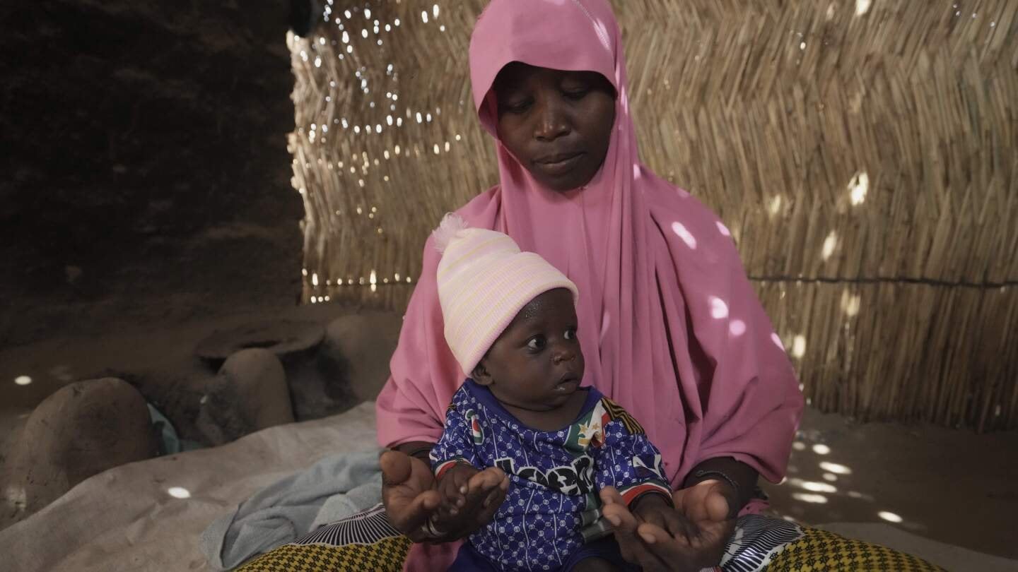 AP PHOTOS: Children die as USAID aid cuts snap a lifeline for the world's most malnourished