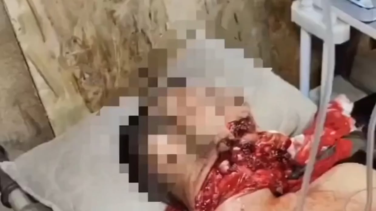 Russian with a missing jaw (VERY NSFW)