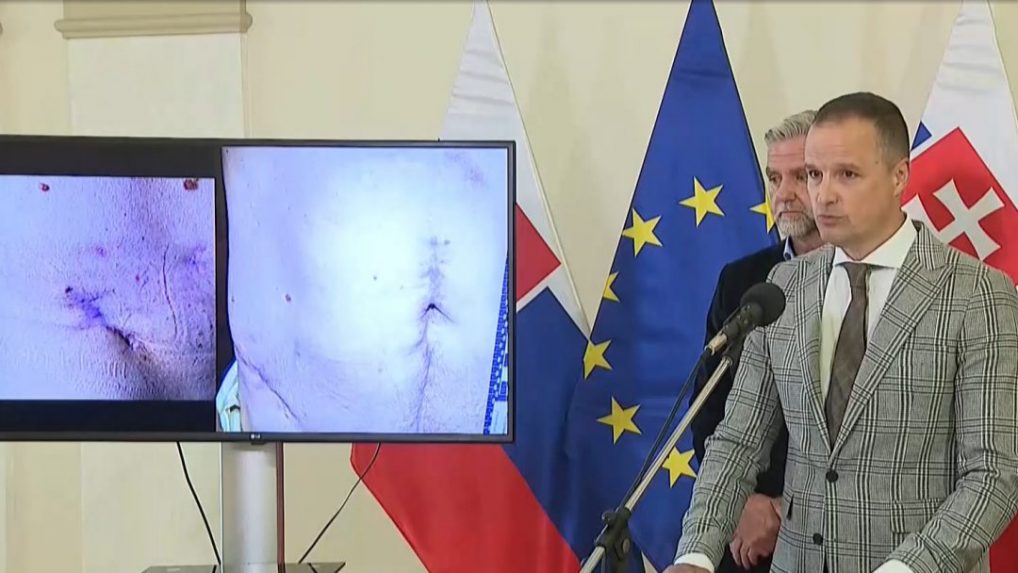 Advokát R. Fica zverejnil zábery zranení premiéra po atentáte v Handlovej