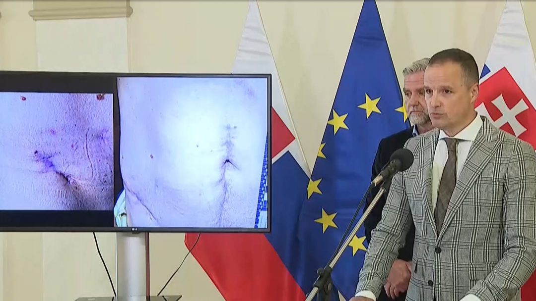 Advokát Fica zverejnil zábery zranení premiéra po atentáte