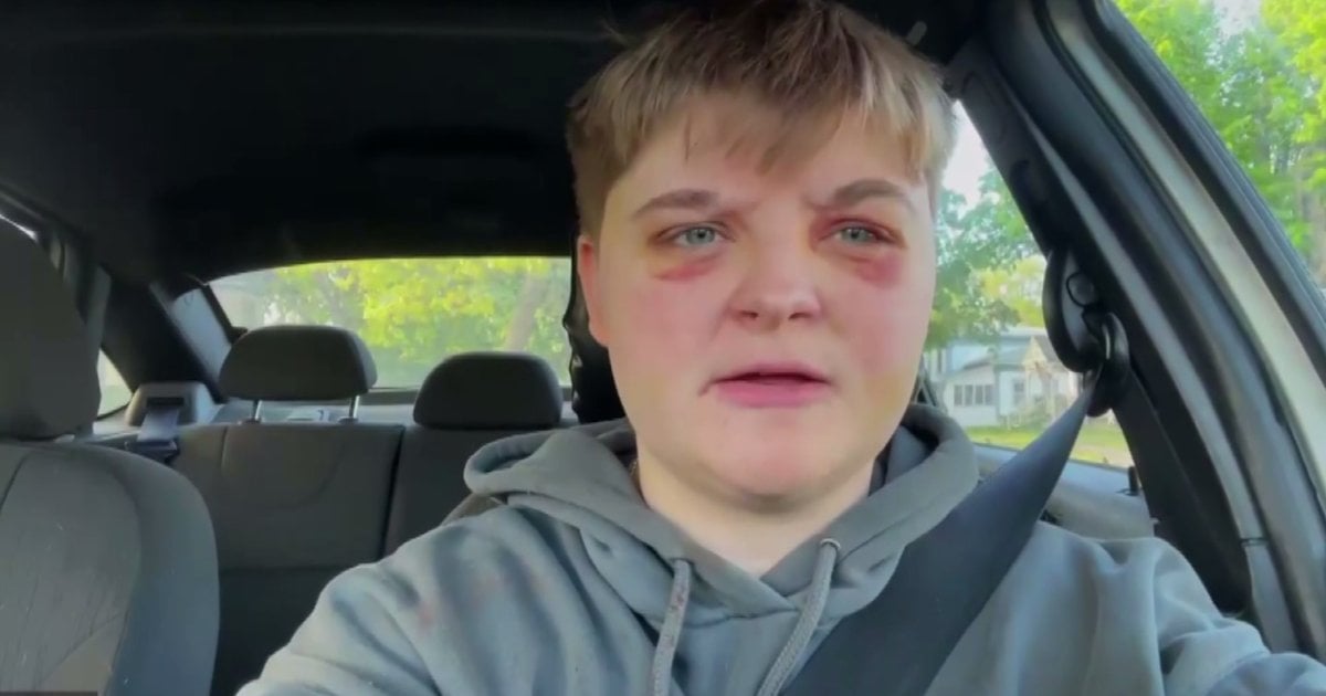 Woman says she was brutally attacked in Carpentersville, Illinois because she's a lesbian