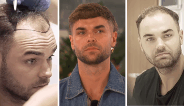 Full video of Harry getting Turkey hair transplant before Love Island