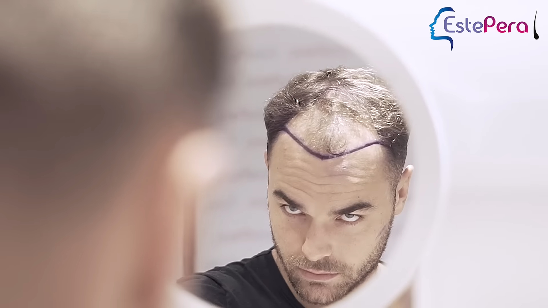 Harry Cooksley had hair transplant before Love Island 2025