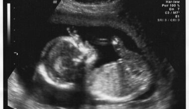 Climate disasters can alter kids’ brains before they’re even born