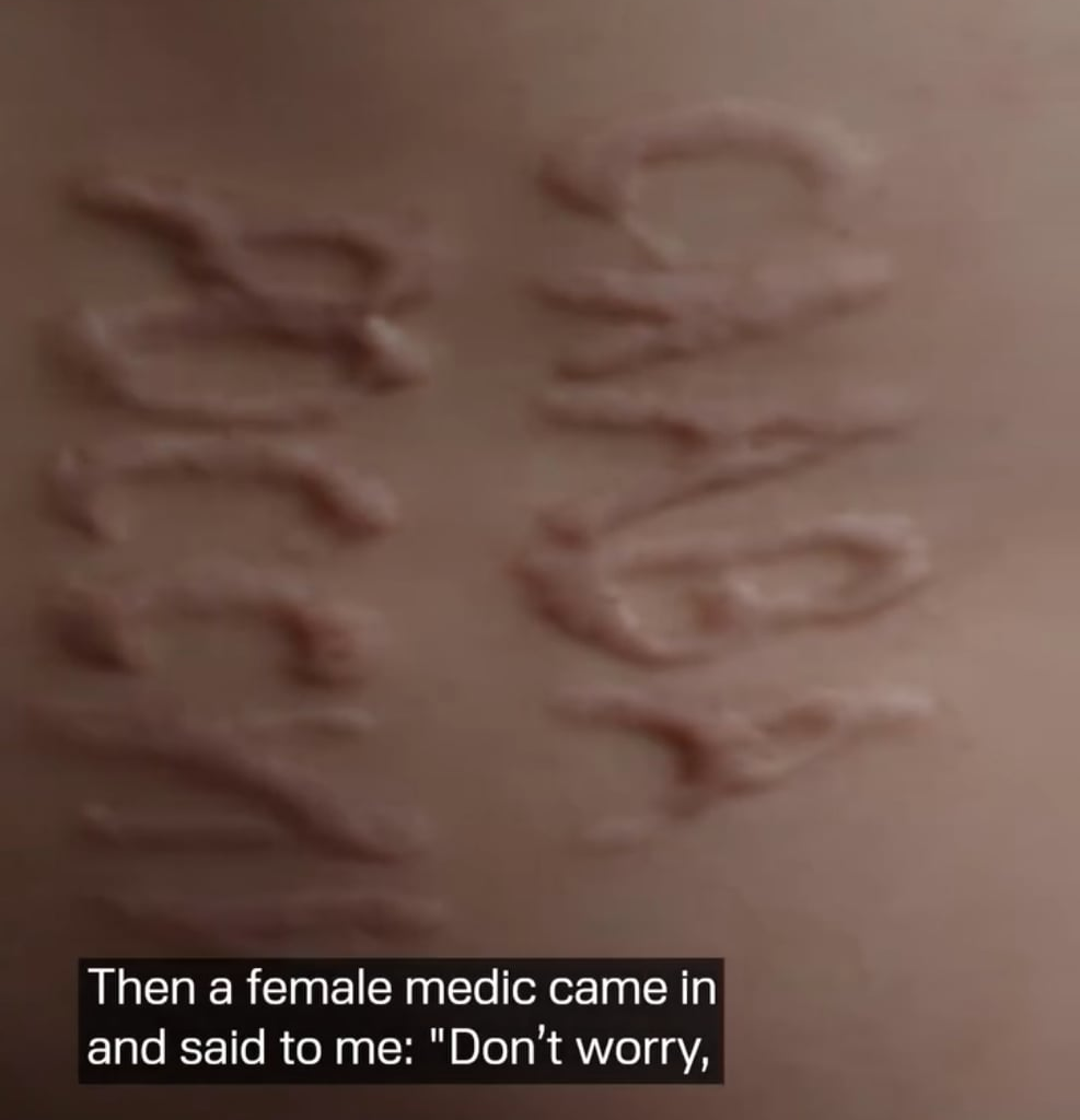 A Russian surgeon burned “Glory to Russia” into his skin during surgery. A recently released Ukrainian prisoner of war reveals his account of captivity.