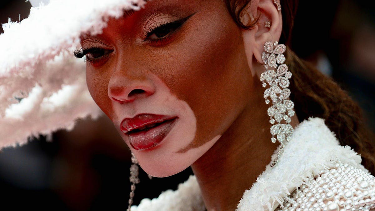 Santé: «Le vitiligo impacte très fortement la qualité de vie»
