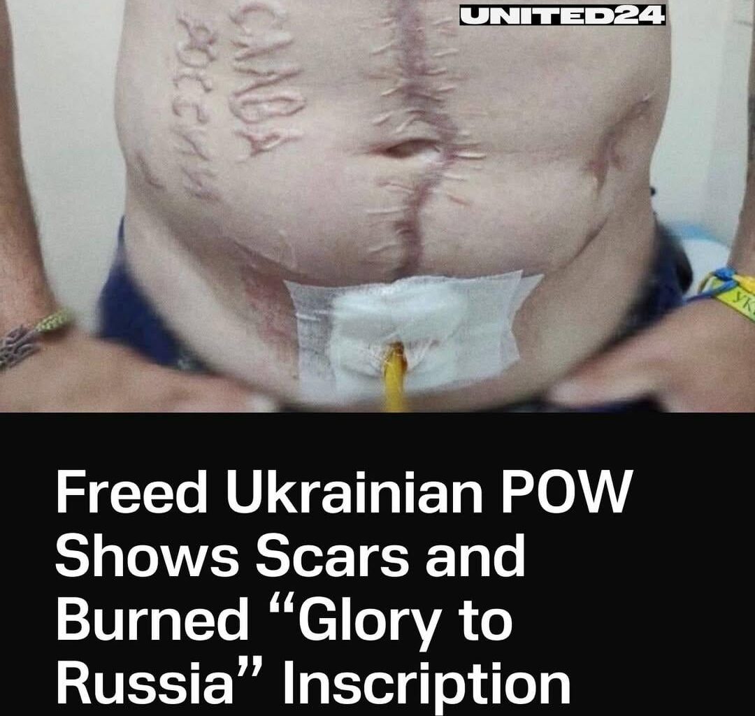A released Ukrainian soldier revealed signs of brutal tortures. His body is covered with mutilations and a burned-in phrase: “Glory to Russia”