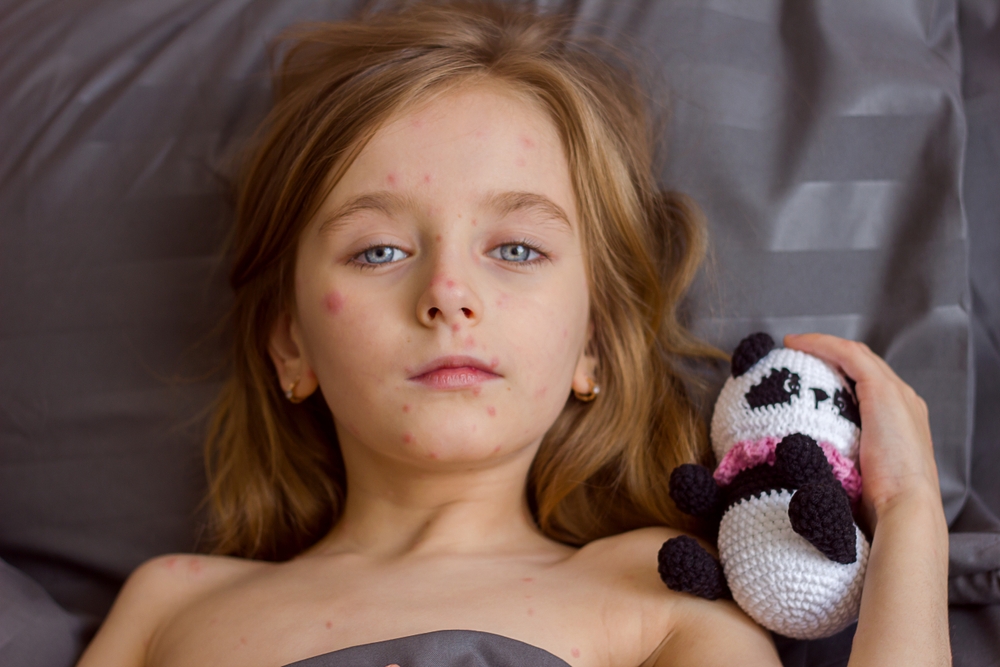 morbillo Italia
