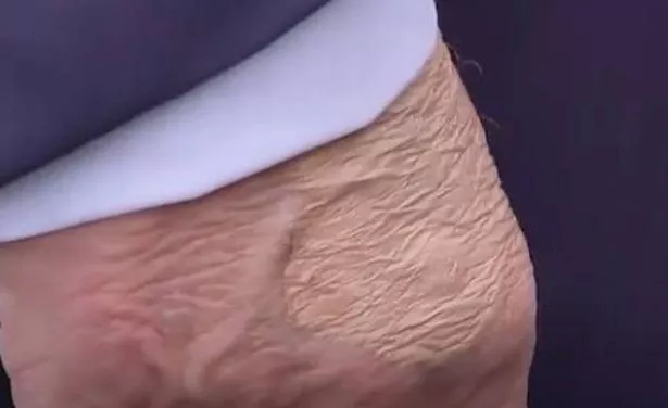 Trump's bruised hand
