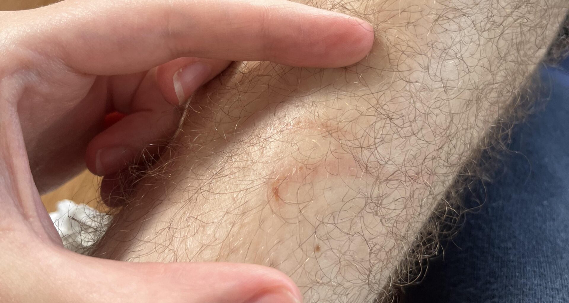 Bitten by dog in Riga - rabies vaccine needed?