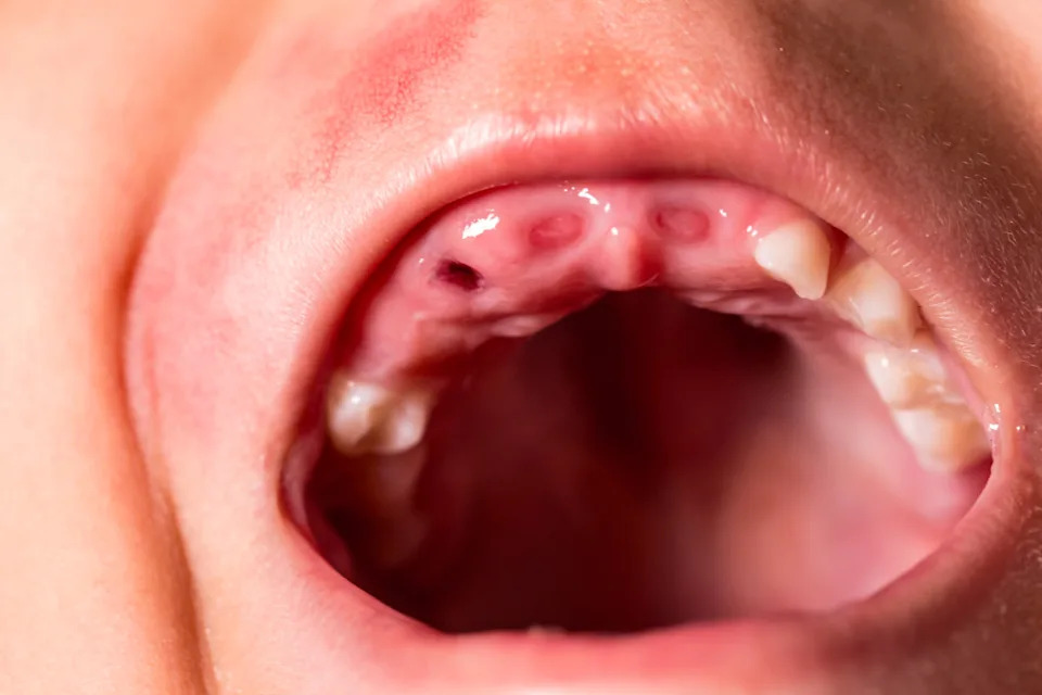 Child with missing teeth<p><a href="https://www.gettyimages.com/detail/942870262" rel="nofollow noopener" target="_blank" data-ylk="slk:Jorge Villalba&sol;Getty Images;elm:context_link;itc:0;sec:content-canvas" class="link ">Jorge Villalba&sol;Getty Images</a></p>