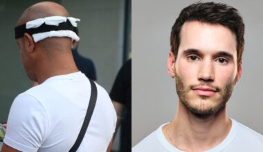 I flew to Turkey for a budget hair transplant. Was it worth it?