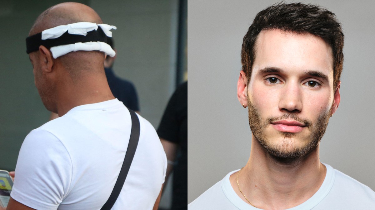I flew to Turkey for a budget hair transplant. Was it worth it?