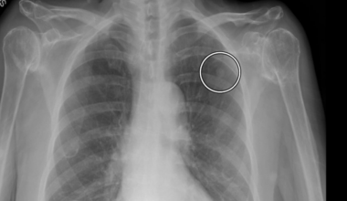 University Hospitals studying use of Artificial Intelligence to improve lung cancer outcomes