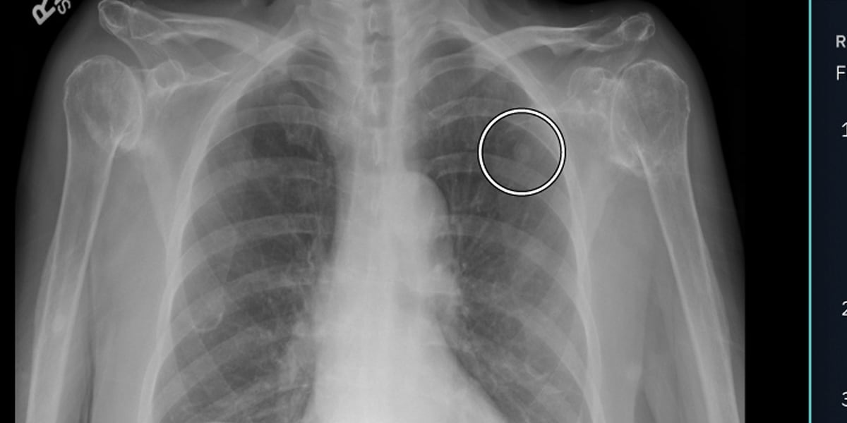 University Hospitals studying use of Artificial Intelligence to improve lung cancer outcomes