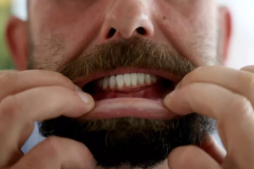 Matthew Bowen shows his new teeth