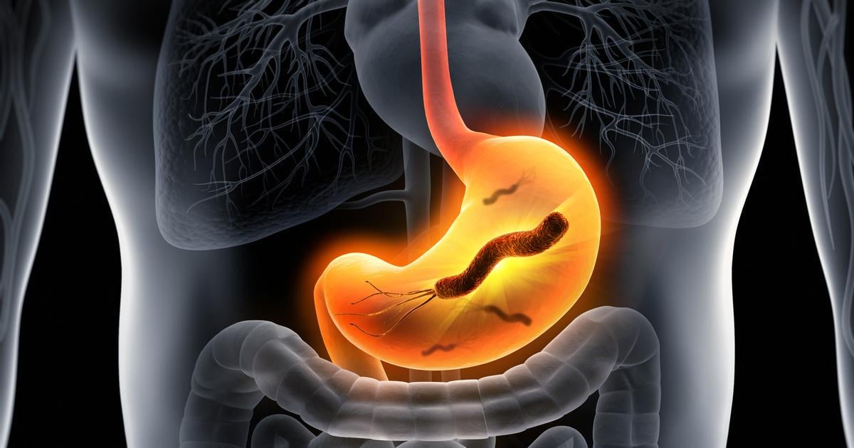 La bactérie Helicobacter pylori pourrait provoquer des millions de cas de cancer de l’estomac dans les années à venir