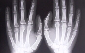 X-ray of hands